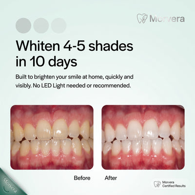 MORVERA 15% Hydrogen Peroxide Teeth Whitening Kit