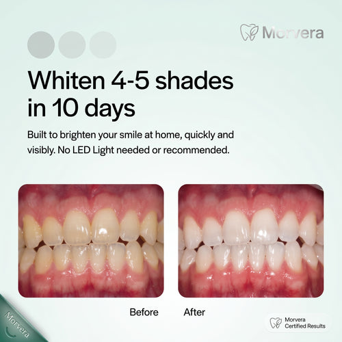 MORVERA 15% Hydrogen Peroxide Teeth Whitening Kit